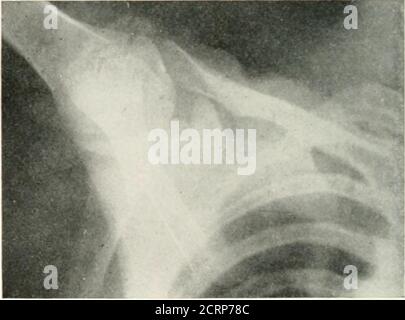 . Radiographie, Röntgentherapeutika und Radiumtherapie . PLATTE VI. – normales Schottldergelenk. n, Xoniales Schultergelenk, Platte auf posteriorem Aspekt des Gelenks.h. Normales Schultergelenk, Platte auf anteriorem Aspekt.c, normales Schultergelenk, Arm abgeführt. DIE UNTERE EXTREMITÄT 135 die untere Extremität die Knochen des Tliebeckens sind in den meisten Röntgenaufnahmen für die Blase und Harnleiter gesehen. Das Kreuzbein ist leicht showai, indem eine Platte beneathder Patient, und usmg ein Kompressionsrohr von oben. In großen Bildern der Region sind die Acetabula mit dem Kopf des Femurs gut dargestellt. Wenn die beiden Gelenke sind Stockfoto