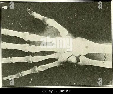 . Die Grundsätze und Praxis der roentgenologischen Technik . Abb. 266. Abb. 267. – Falsche Anordnung. Die Gelenkenden der Knochen überlagern sich. Stockfoto