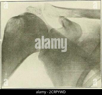 . Die Grundsätze und Praxis der roentgenologischen Technik . Abb. J59 180 SCHULTER. Abb. 260. - Acromio-klavikuläre Ansicht des schultershouldershowing coracoid process. Stockfoto
