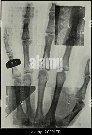 . Elementare und zahnärztliche Radiographie . Abb. 312. A, B, C und D, wie in Abb. 311. E, ein Stück Bleiglas 1-4 Zoll dick. Vom Standpunkt des Schutzes für den opero- CBE ECAD Screen ator ist nichts so effizient wie der Lead Screen oder Cabi- und Cabinet, net (Abb. 314, 315, 316 und 317). Der Einsatz von entweder ermöglicht es dem Bediener, sich vollständig vor allen direkten Röntgenstrahlen zu schützen. Das Blei in Schutzsiebe und Schränke verwendet wird, ist in der Regel ein-sechs- DIE GEFAHREN OE DIE X-RAY 281. Abb. 313. A, B, C. und D, wie in Abb. 311. E, die gepunkteten Linien umreißen die Position eines Stückes Stockfoto