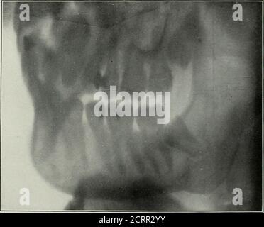 . Elementare und zahnärztliche Radiographie . hergestellt auf einer großen Platte (Abb., loi und 102) oder einem Film auf der Außenseite des Mundes (Abb. L 97, S. Mit dem Theradiograph, um den Verdacht zu bestätigen und die genaue Lage des Zahns zu zeigen, kann der Bediener den Patienten betäuben, den Mund mit einer Mundstütze öffnen und den Zahn extrahieren. Abb. 299 ist ein Fall, in dem der Mund konnte Tig. 299. Nicht geöffnet werden, weil der Entzündung durch den betroffenen unteren dritten Molar im Radio-Graph gesehen verursacht. Run Verwendungen von Wanne RADiocRArii jx Dextjstry 263 62. TN Research Ulork zum Studium der Osteologie, der Entwicklung Stockfoto