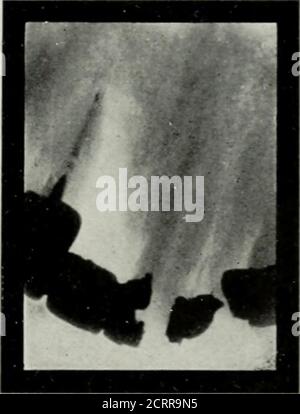 . Elementare und zahnärztliche Radiographie . Abb. 188 Abb. 189 Abb. 188. Ein Abszess an der Spitze eines oberen seitlichen Schneidezapfens. Dieser Abszess spitz direkt über den Dummy-Mittelinzisor, der auf einer Postkronenkrone seitlich eingeschwenkt ist, und eine Einlage im Mittelinzisor. Die zentralen Dokumente zeigen nicht klar, – aber deutlich genug, um zu zeigen, dass es keine Abszesshöhle an ihrem Scheitelpunkt gibt.Abb. L 185, S. Wie in Abb. ]SS zwei Wochen nach Küreterung des Eiter Sinus. Es gibt einige Ablagerung des neuen Knochens. 20. In €A-CAD von alveolar nb-CAD um festzustellen, dass Ulbicb Cooth für Tbe Jibscess verantwortlich ist. Fall: Eine Eiter-Sünde Stockfoto