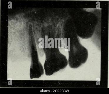 . Elementare und zahnärztliche Radiographie . Abb. 160. Abb. 161. Abb. 160. Betroffener upi)cr Dritter Molar. (Röntgenaufnahme von Lewis aus Chicago.) Abb. 161. Betroffener oberer dritter Molar. Beachten Sie die in diesem Fall und in Abb. 160. (Röntgenaufnahme von Blum, von New York City.) Stockfoto