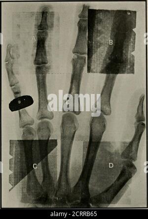 . Elementare und zahnärztliche Radiographie . Abb. 818. A. B, C und l». BAME wie in Abb. 811. I-., ein Stück Bleiglas 1-1 Zoll dick. Vom Standpunkt des Schutzes für den oper- thc CCAD Screen ator n&lt;-Thing ist so effizient wie der Lead Screen oder Cabi- und Cabinet, nel (Abb. 314, 315, 316 und 317). Der Einsatz von entweder ermöglicht es dem Bediener, sich vollständig vor allen direkten Röntgenstrahlen zu schützen. Das Blei in Schutzschirmen und Schränken verwendet wird, ist in der Regel ein-sechs- DIE GEFAHREN DER Röntgenstrahlung 281. Abb. 313. A, B, C und D, wie in Abb. 311. E, die gepunkteten Linien umreißen die Position eines Stockfoto