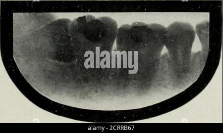 . Elementare und zahnärztliche Radiographie . Abb. 160. Abb. 161. Abb. 160. Betroffener upi)cr Dritter Molar. (Röntgenaufnahme von Lewis aus Chicago.) Abb. 161. Betroffener oberer dritter Molar. Beachten Sie die in diesem Fall und in Abb. 160. (Röntgenaufnahme von Blum, von New York City.). Stockfoto