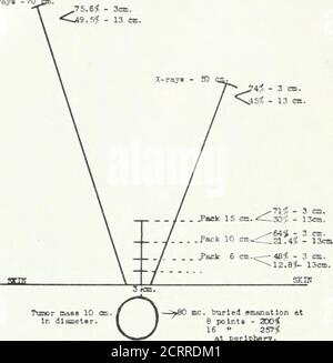 . Archive of Physical Medicine and Rehabilitation . o tion at 8 Points Abb.6 – Diagramm zeigt den relativen Wert der vergrabenen Radiumemanation, gefilterten Nidiimi extern, und Hochspannungs-X-iays.Prozentsätze sind in Begriffen cif Erythema Dosis an der Hautoberfläche.iken AS 100. Infiltrierte Radiumemanationsdosen, berechnet nur für 7-Strahlen, Hadlnm-Factori: Filter, 2 mm. Messing durchmessend; Packungsdosis al 15 cm. ^ 42.000 mc. Std.; bei 10 cm. = 20.000 mc. H; bei 6 cm. = 10.001 mk. Std., Trav-Dosis bei 3 cm = 2200 mk. hri. 319 rXFILTERED RADIUM EMANATION IN DEEP THERAPY – QUICK SCfflf* :»Strahlungsfaktoren: 200 kv. , großes Feld*, i Stockfoto