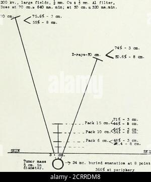 . Archive der Physikalischen Medizin und Rehabilitation . NT. 1. 16 mc. Gegrabene Radlm amanatloverteilt an 8 Punkten 694 i an der Peripherie. Abb. 1 – D^..r. n- tinv.-iif lelativer Wert der vergrabenen Radiumemanation, des gefilterten Radiums extern und der Hochspannung x-raya.Prozentsätze beziehen sich auf die Erythemdosis an der Hautoberfläche als 100. Ungefleckte Radiumemanationsdosen kalkuliertfür -y-Strahlen nur Sadlam-Faktor*: Filter, 2 mm. Messing durchmessend; Packung do-e bei 15 cm. = 42,000 mc. Std.; bei 10 cm. = 20.000 mc. H; bei 6 cm. = 10.000 mc. Std. Tablette Dosis bei 3 cm =2200 mc, Std. Röntgenfaktoren: 300 ICT., largo-Felder. Stockfoto