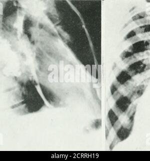 . Archive der Physikalischen Medizin und Rehabilitation . Abb. 10 – Iiiuig^ Abszess aufgrund von suppuiaticnof a iineumonic U-ocess in der Lunge, (a) Abszess cpn zu sehen, (b) aber in themade out. Beachten Sie die Verdickung des Tlie inlof der Lappen. Eines Hiluslymphknotens nach DrainageIn der anterioren Ansicht nichts verdächtiouslatäre Ansicht der definitive Abszess kann sein:Erlobarpleura Mapping out the confines i. Stockfoto