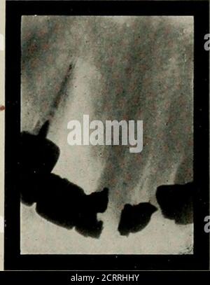 . Elementare und zahnärztliche Radiographie . Abb. 188 Abb. 189 Abb. 188. Ein Abszess an der Spitze eines oberen seitlichen Schneidezapfens. Dieser Abszess spitz direkt über den Dummy-Mittelinzisor, der auf einer Postkronenkrone seitlich eingeschwenkt ist, und eine Einlage im Mittelinzisor. Die Zentralstelle zeigt nicht klar, – aber deutlich genug, um zu zeigen, dass es keine Abszesshöhle an ihrem Scheitelpunkt gibt.Abb. 189. Das gleiche wie Abb. 188 zwei Wochen nach Küreterung des Eiter Sinus. Es gibt einige Ablagerung des neuen Knochens. 20. TN Fälle von Alveolarabszess, um festzustellen, welcher Zahn für den Abszess verantwortlich ist. Fall: Ein Eiter Sinus Stockfoto