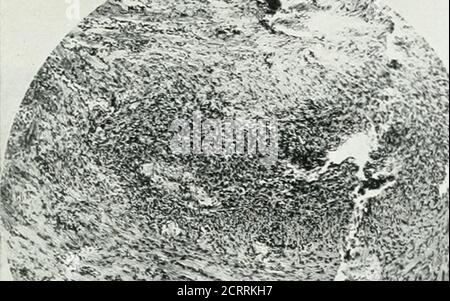 . Archive der Physikalischen Medizin und Rehabilitation . Flg-. 3-A-Fathol. Nr. 30G16. Fall 1.Ferlostenl-Sarkom, ossifyingr-Typ.Fhotograph von louRfitucllual sectiontlirouffli Upper enrt of femur undTumor nach Amputation am lilp Joint.Es gab zwei exploratorische Operationen mit partieller Exzision. Es ist offensichtlich, dass der Periosteal frrowtlihas in der Größe seit dem x-raySeptember 5 erhöht. 1922 (siehe WIG. L 157, S. 3) Thesrross Bild ist, dass der Sarkom nnddas Mark ist mit Tumor beteiligt. KNOCHENTUMOREN: SARKOM – BLUTGUT. Stockfoto