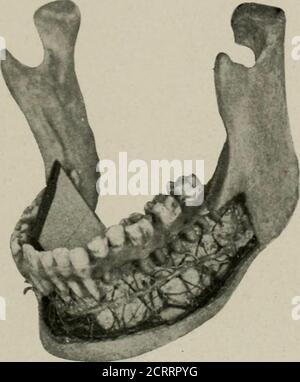 . Elementare und zahnärztliche Radiographie . in Abb. 88, ami die Röntgenaufnahme aus dieser Pose. Die Wurzeln ist es, weil der Film nicht weit genug gedrückt wurde, oder thetube war nicht niedrig genug. Die leichten Unterschiede in den Posen zu den Makeradiographien der Vorderzähne und der dritten Molaren aus dem Posteshown in Abb. 91 sind offensichtlich. Mit dem Film in den Mund wie in Abb. 89. Außer mit der sensitiven Seite des Films, die sich in Richtung der unteren statt der oberen Zähne zeigt, und einer Pose nach Abb. 92, Röntgenaufnahmen der unteren Zähne können bemaden. MACHEN VON RÖNTGENAUFNAHMEN 97 der Abstand der Röhre ist p Stockfoto