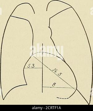 . Das Herz und die Aorta; Studien in der klinischen Radiologie . der aurikulo-ventrikularorifice der linken sowie der rechten Seite. Mitralinsuffizienz wird nicht immer durch eine infektiöse endo-carditis verursacht. Es gibt viele Fälle, in denen es nur als Epiphänomen im Verlauf der Herzdilatation erscheint.in diesen Fällen ist es wichtig zu wissen, wie genau diese Dilatation ist, mehr noch als das Vorhandensein eines systolischen Murmurs an der Spitze. Thoughauskultation ermöglicht eine Diagnose dieses Murmurs zu bemaden, es ist nicht in der Lage, die pathogenen Bedingungen, die PR zu enthüllen Stockfoto