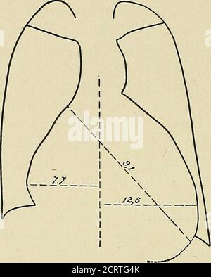 . Das Herz und die Aorta; Studien in der klinischen Radiologie . rdinäre Methoden der radiologischen Untersuchung.das Teleradiogramm (Abb. 70) ist ein typischer Fall. Die AP-pearance von schweren Funktionsstörungen nur in-Falten ventrikuläre Hypertrophie, die ex-cessive Dimensionen erreichen können, wie in Abb. 71. Die radiologische Untersuchung kann auch die Koexistenz mit der Aorteninsuffizienz der Valvulären Kardiopathie, insbesondere der Mitralstenose, nachweisen. Das ist interessant, denn es wurde aus rein theoretischen Gründen angenommen, dass die Assoziation dieser beiden Läsionen ein rathergünstiger Zustand war Stockfoto