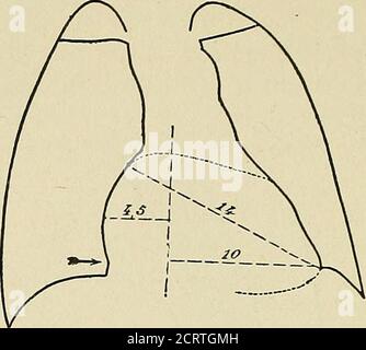 . Das Herz und die Aorta; Studien in der klinischen Radiologie . ig. 53. BIGHT POSTEEIOE OBLIQUE POSITION, 50 DEGBEES.MODEEATE ERWEITERUNG DER LINKEN AUEICLE MITRALINSUFFIZIENZ die klinische Anamnese der Mitralinsuffizienz stellt Probleme dar, von denen die Lösung von zwei zumindest noteasisch ist. Die erste ist, ob das systolische Murmur gehört atthe Apex gehört einfach zu der Kategorie der anorganicmurms (Potain); die zweite ist zu erkennen, die Ursache von it, wie das Murmur kann symptomatisch für eine Valvularläsion oder der funktionellen Insuffizienz sein. In dieser Hinsicht sind die von der Semeiologie eingerichteten Hinweise oft Stockfoto