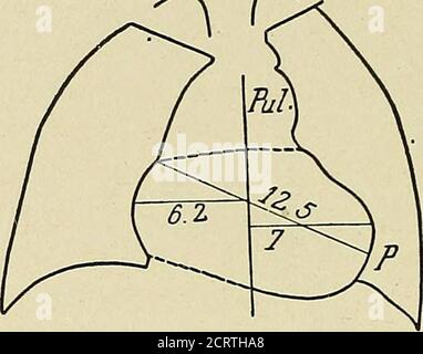 . Das Herz und die Aorta; Studien in der klinischen Radiologie . besonders zum hinteren Teil des Organs; wenn es zunimmt, tut es dies nicht nur nach links, sondern auch in seinem anteroposterioren Durchmesser. Da es sich um die Projektion der postero-lateralen Kontur des linken Ventrikels handelt, die auf der Leinwand in der rechten poste-rior schrägen Position gezeigt wird, ist es ganz natürlich, dass dieser Schatten, wenn er einer vergrößerten Kavität entspricht, langsam auftaucht. Es wird auch verstanden, dass bei der Suche nach dem Index in der Tiefe, der schräge Strahl die Kontur 68 DAS HERZ UND DIE AORTA des Herzens unteren dow trifft Stockfoto