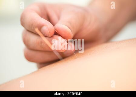 Detail der Anwendung von Akupunkturnadeln auf dem Rücken eines Patienten Stockfoto