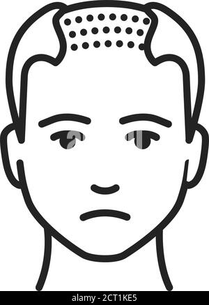 Mann mit einem kahlen Kopf schwarze Linie Symbol. Kahlheit Stadium. Alopezie. Piktogramm für Webseite, mobile App, Promo. UI UX GUI Design Element. Bearbeitbare Kontur. Stock Vektor