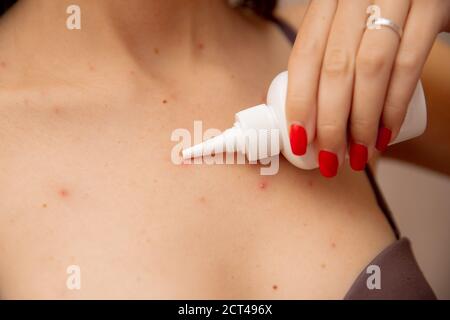Close up Frau Anwendung Creme auf Haut krank mit Windpocken Stockfoto