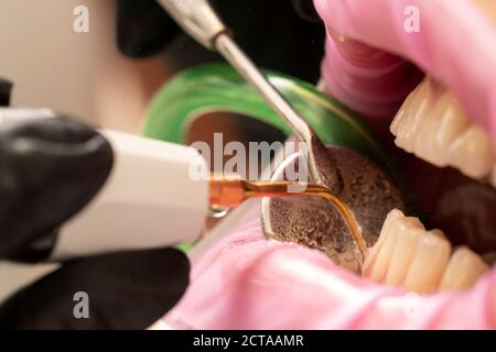 Nahaufnahme der Zahnstein Zahnstein Entferner Werkzeug Stockfoto