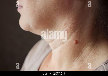 Nahaufnahme eines Maulwurfs am Hals einer Frau. Stockfoto