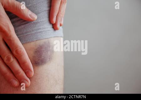 Bluterguss am Bein. Injektionsblaue Flecken. Verletzungen der Wunden und Verletzungen der Haut Stockfoto