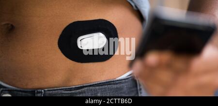 Mann Testen Blutzuckerspiegel mit Continuous Glucose Monitor auf dem Mobiltelefon Stockfoto