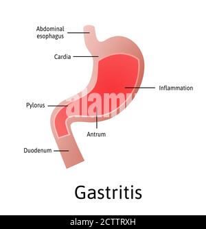 Gastritis, eine Entzündung, Reizung oder Erosion der Magenschleimhaut. Medizinische Vektordarstellung mit Linien gekennzeichnet. Alle Teile des Magens Stock Vektor