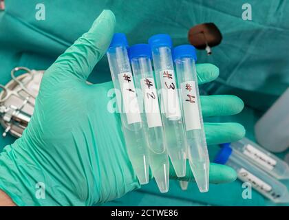 Fläschchen mit vier Proben von Liquor bei Patienten mit transversaler Myelitis nach Injektion mit einem experimentellen Oxford-Covid-19-Impfstoff, Stockfoto