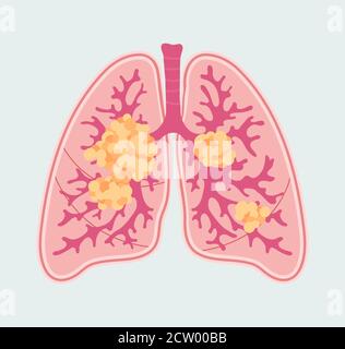 Patientenfreundliches Schema von Lungenkrebs. Anatomisches Diagramm von Tumor und Metastasen in den Atmungsorganen Stock Vektor