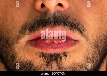 Nahaufnahme von schmerzhaften Lippenherpes oder Herpes-Virus auf der Lippen des Mannes. Stockfoto