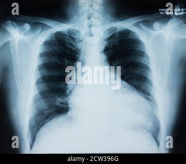 Röntgenbild des Brustkorbs für die medizinische Diagnose. Stockfoto