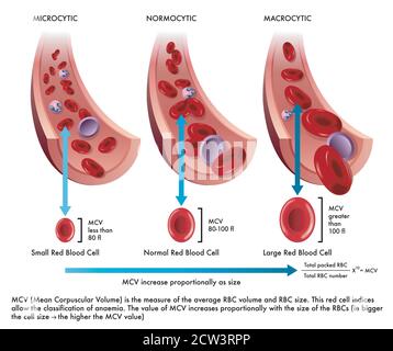 Abbildung zeigt den Unterschied zwischen einer normalen roten Blutkörperchen mit einer von Mikrozytose und einer anderen von Makrozytose befallen, mit Anmerkungen Stock Vektor