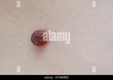 Angeborener Maulwurf aus nächster Nähe. Makroaufnahme der gutartigen Hautläsion. Proliferation von Pigment-Derma-Zellen, melanozytären pigmentierten Naevus, naevozytären Nevus. Stockfoto