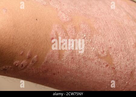 Krankheiten, die durch Anomalien der Lymphe verursacht werden. Psoriasis ist eine Hauterkrankung. Stockfoto