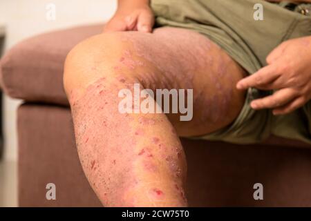 Krankheiten, die durch Anomalien der Lymphe verursacht werden. Psoriasis ist eine Hauterkrankung. Stockfoto