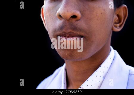 Nahaufnahme der menschlichen Lippen leiden an Herpes-Krankheit. Stockfoto