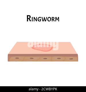 Ringwurm auf der Haut. Vektorgrafik auf isoliertem Hintergrund Stock Vektor