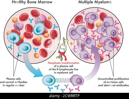 Medizinische Illustration zeigt die Umwandlung von Plasmazellen im gesunden Knochenmark in Myelomzellen im Multiplen Myelom, bedingt durch DNA-Schäden. Stock Vektor