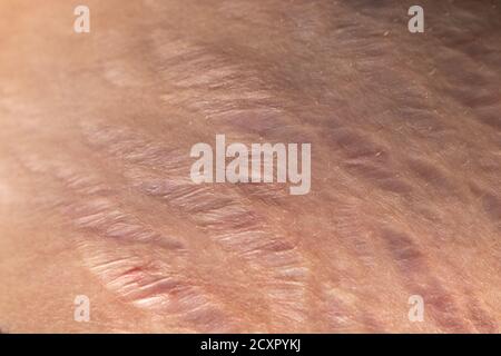 Dehnungsstreifen auf der Haut Nahaufnahme. Körpernarben Stockfoto