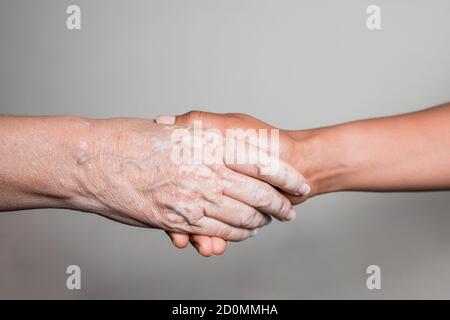 Die Hand einer jungen Frau hält eine ältere Hand mit Vitiligo-Störung Stockfoto