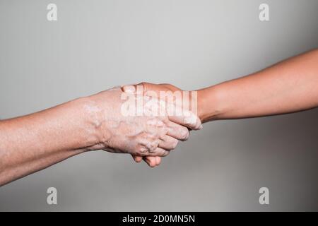 Die Hand einer jungen Frau hält eine ältere Hand mit Vitiligo-Störung Stockfoto