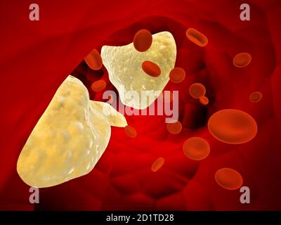 Cholesterinplaque in Arterie (Atherosklerose) und Erythrozyten. Arteria Verstopft. 3d-Rendering Stockfoto