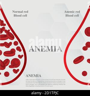 Anämie Menge des roten Blutes Eisenmangel Anämie Unterschied der Anämie Menge der roten Blutkörperchen und normale Symptome Vektor Illustration medizinisch. Stock Vektor