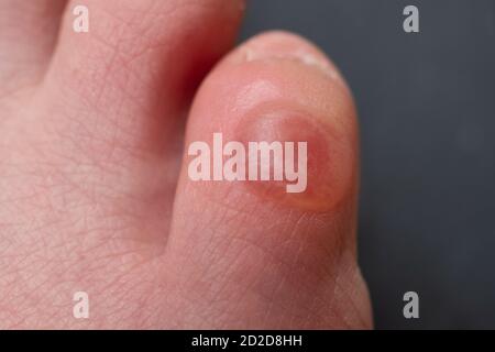 Callus auf pinkigen Zehen nach dem Tragen von unbequemen Schuhen. Nahaufnahme. Stockfoto