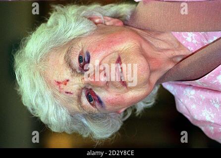 Die 84-jährige Madeline Levasseur aus Erdington, Birmingham, erlitt am Dienstagabend einen gebrochenen Arm und ein gebrochenes Halsbein, als sie von einem Räuber auf den Boden gedrückt wurde, während sie zur Kirche ging. Miss Levasseur wird heute (Donnerstag) im Good Hope Hospital, Sutton Coldfield bei der Genesung abgebildet. Foto von David Jones. SEHEN SIE SICH DIE PA-GESCHICHTE AN. Stockfoto