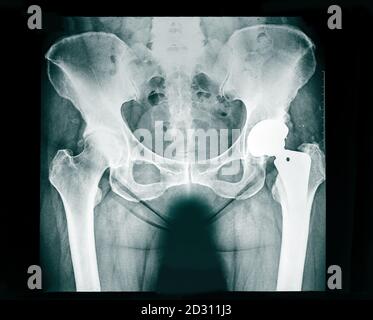 Röntgenaufnahme der Endoprothese des Beckens, der für rheumatische Erkrankungen des Hüftgelenks und rheumatoider Arthritis verwendeten Gelenkhöhle Stockfoto