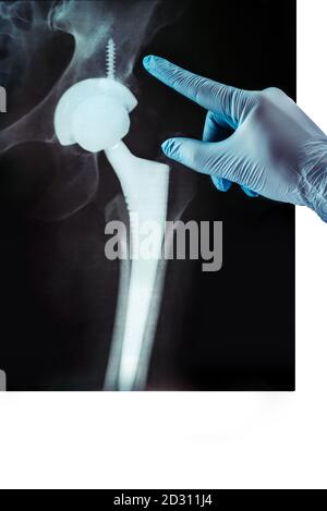Röntgenaufnahme der Endoprothese des Beckens, der Gelenkshöhle rheumatischer Erkrankungen und rheumatoider Arthritis Stockfoto