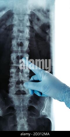 Röntgenaufnahme der Lendenwirbelsäule Radiologie RTG blau Handschuh spitz Stockfoto