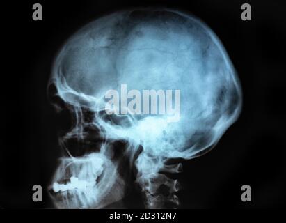 Menschlicher Schädel Röntgenbild isoliert auf schwarz Stockfoto