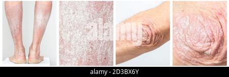 Panel Collage von akuter Psoriasis an den Ellbogen und Beinen eines Mannes - eine autoimmune unheilbare dermatologische Hauterkrankung. Großer, roter, wund, schuppiger Ausschlag Stockfoto